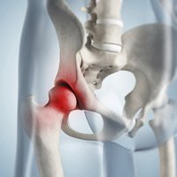 Hip/Pelvic Pain Image